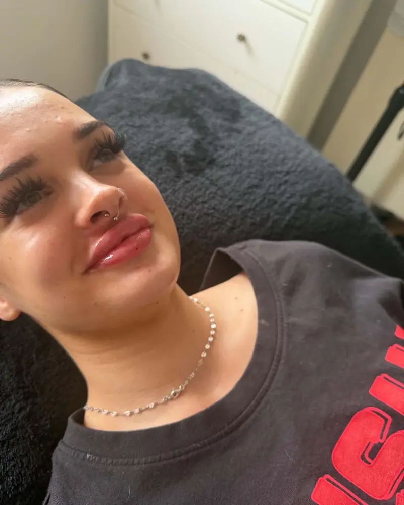 Client with full, glossy lips relaxing on the treatment couch