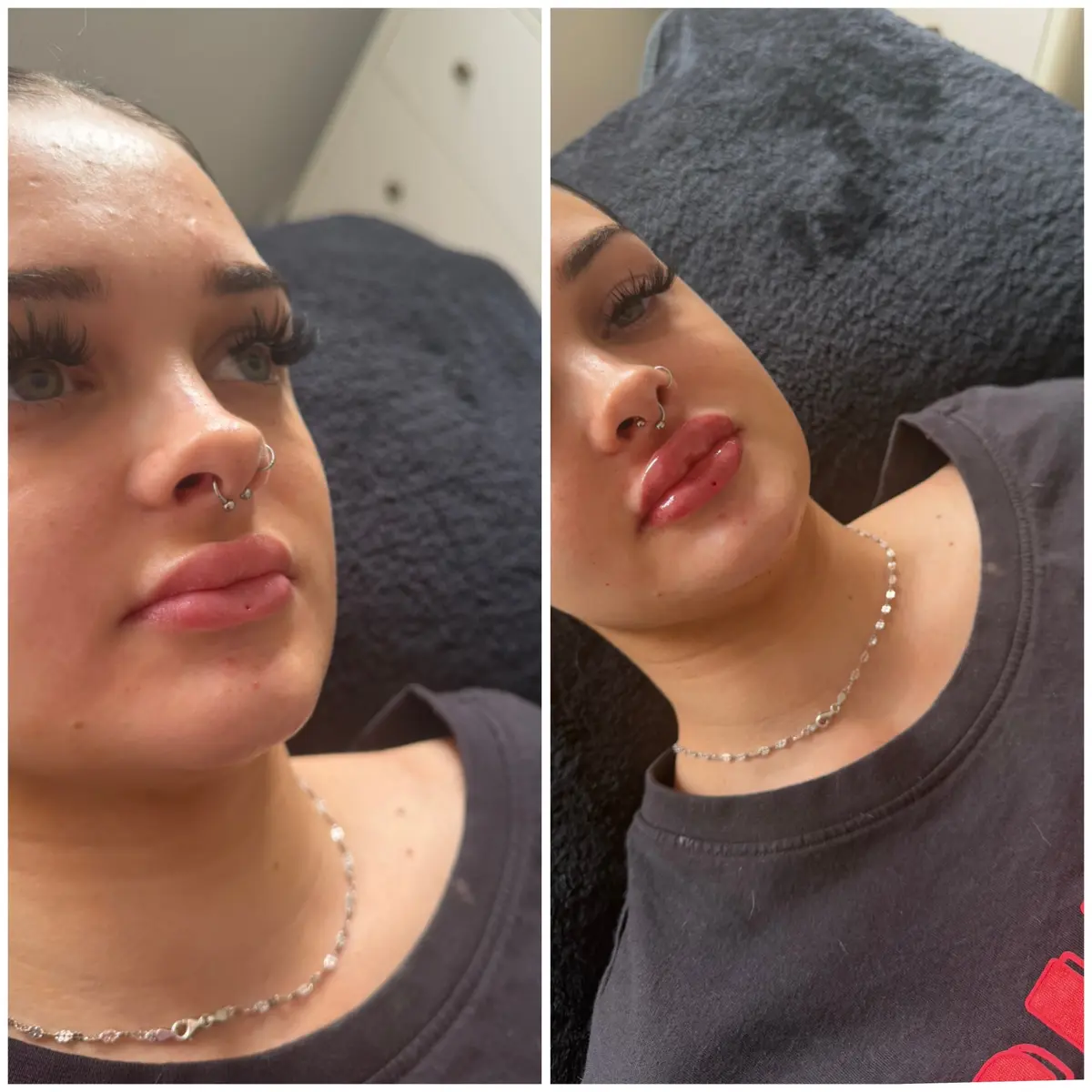 Lip filler before and after: natural lips on the left, fuller, more defined lips on the right