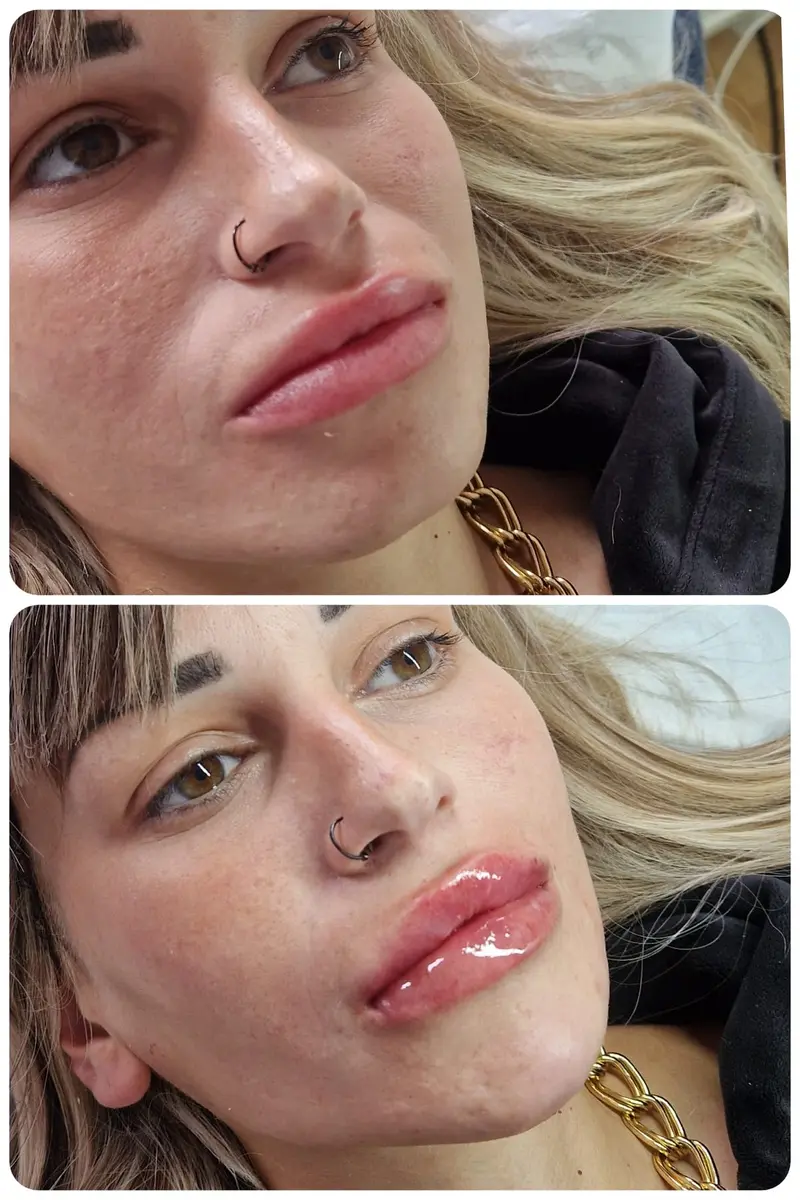 Before (top) and after (bottom) lip, chin, cheek and jaw filler: fuller, glossier lips with a more defined chin, cheeks and jawline